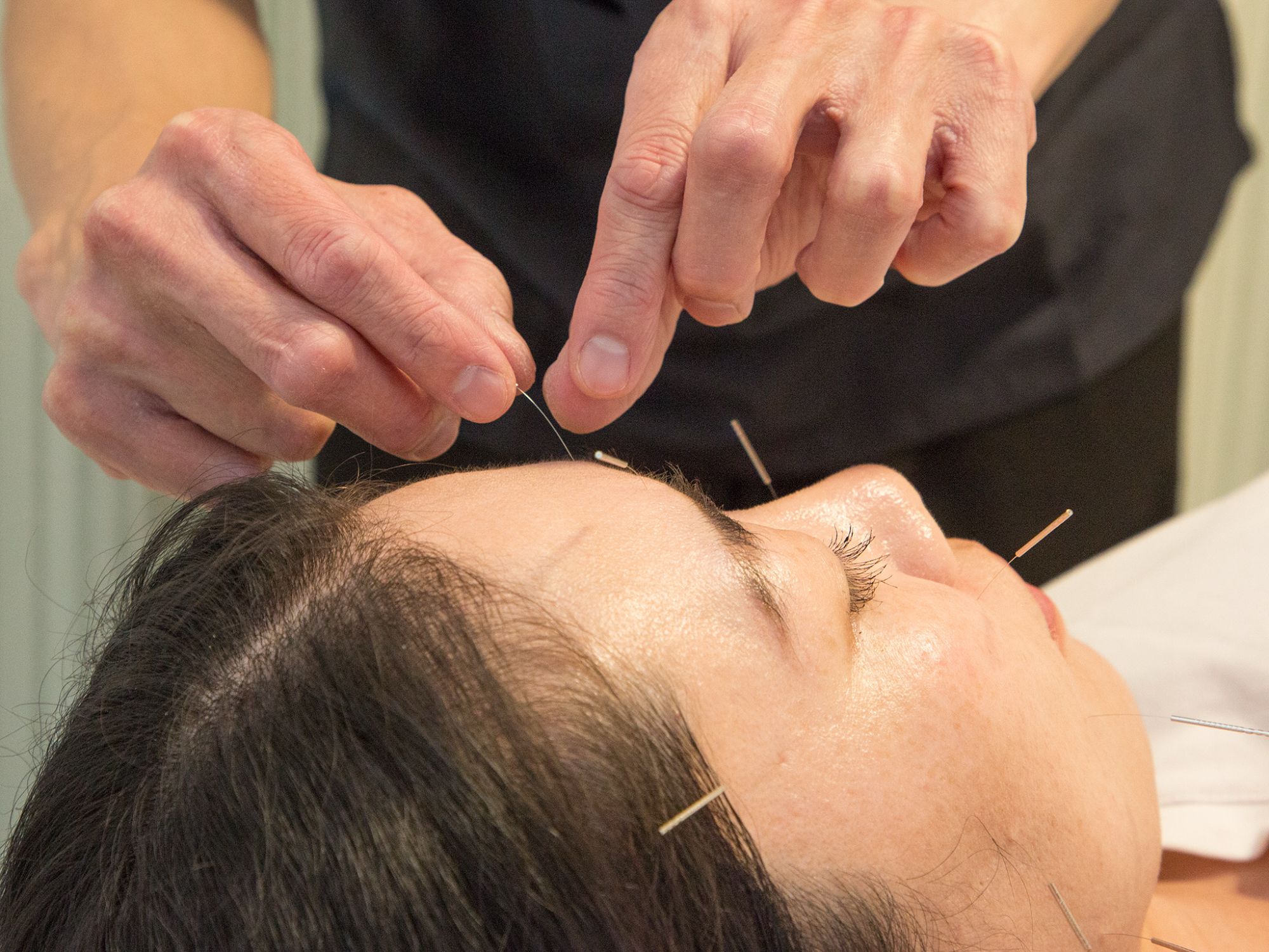 美容鍼施術風景
